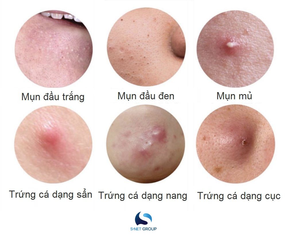Phân biệt các loại mụn thường gặp